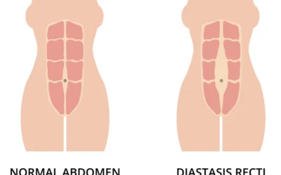 Diastasis Recti: What You Should Know