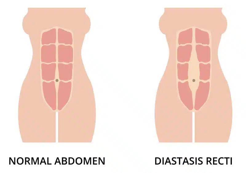 Side-by-side illustration showing a normal abdomen with abdominal muscles close together on the left, and diastasis recti with separated abdominal muscles on the right. Both images show the torso from the front.